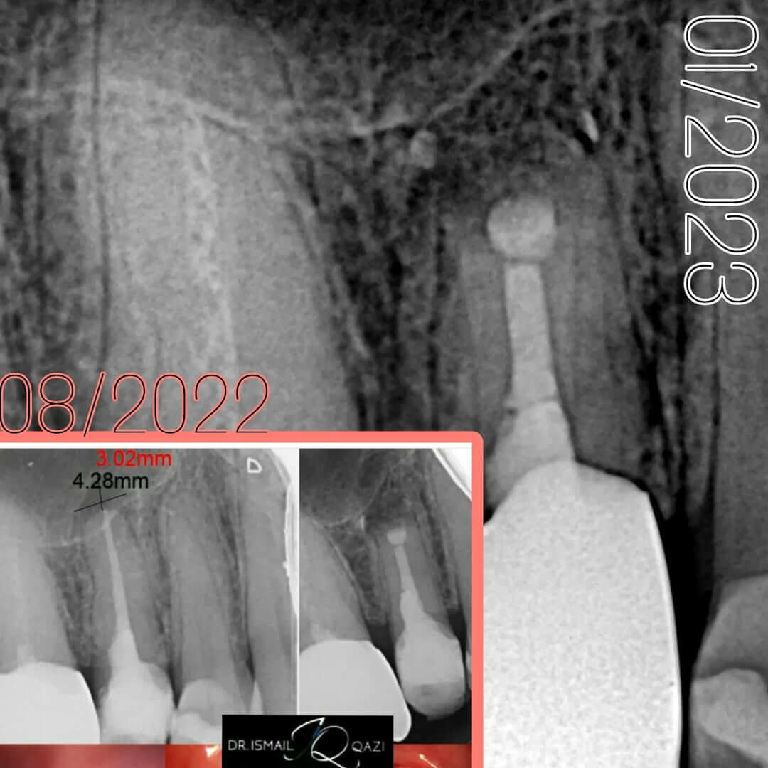 Apicetomy before and after