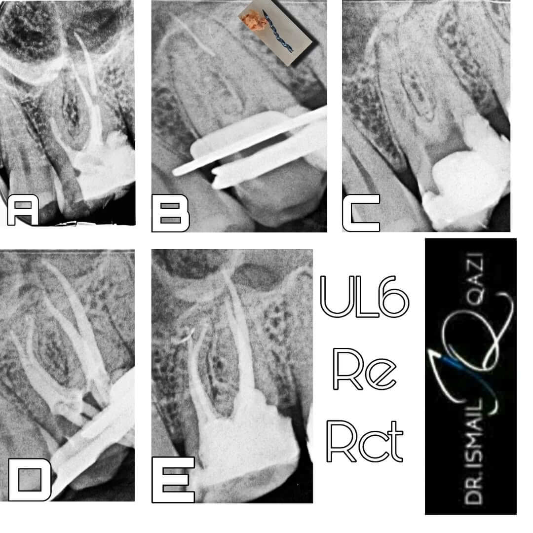 Broken file removal before and after