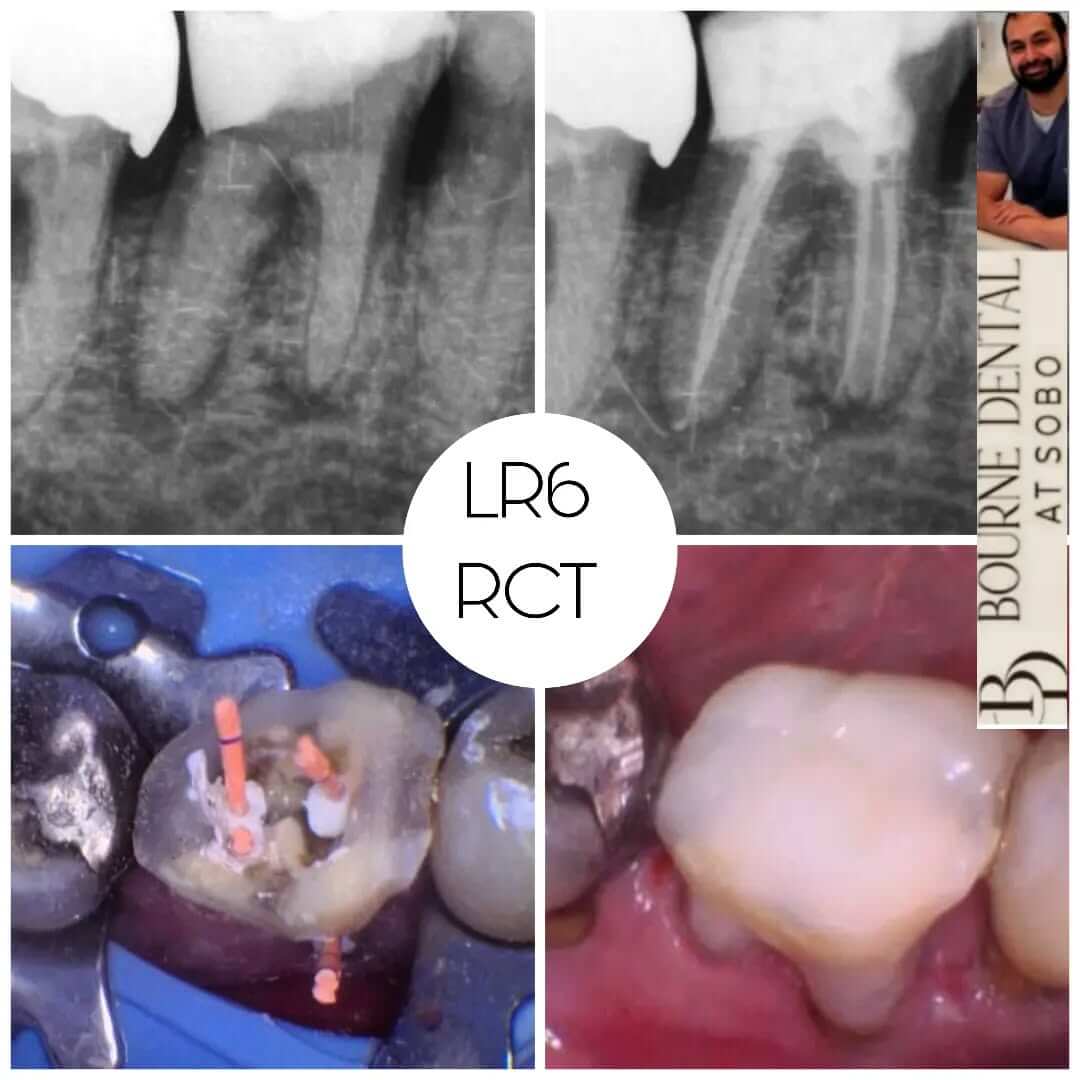 Deep margin elevation before and after