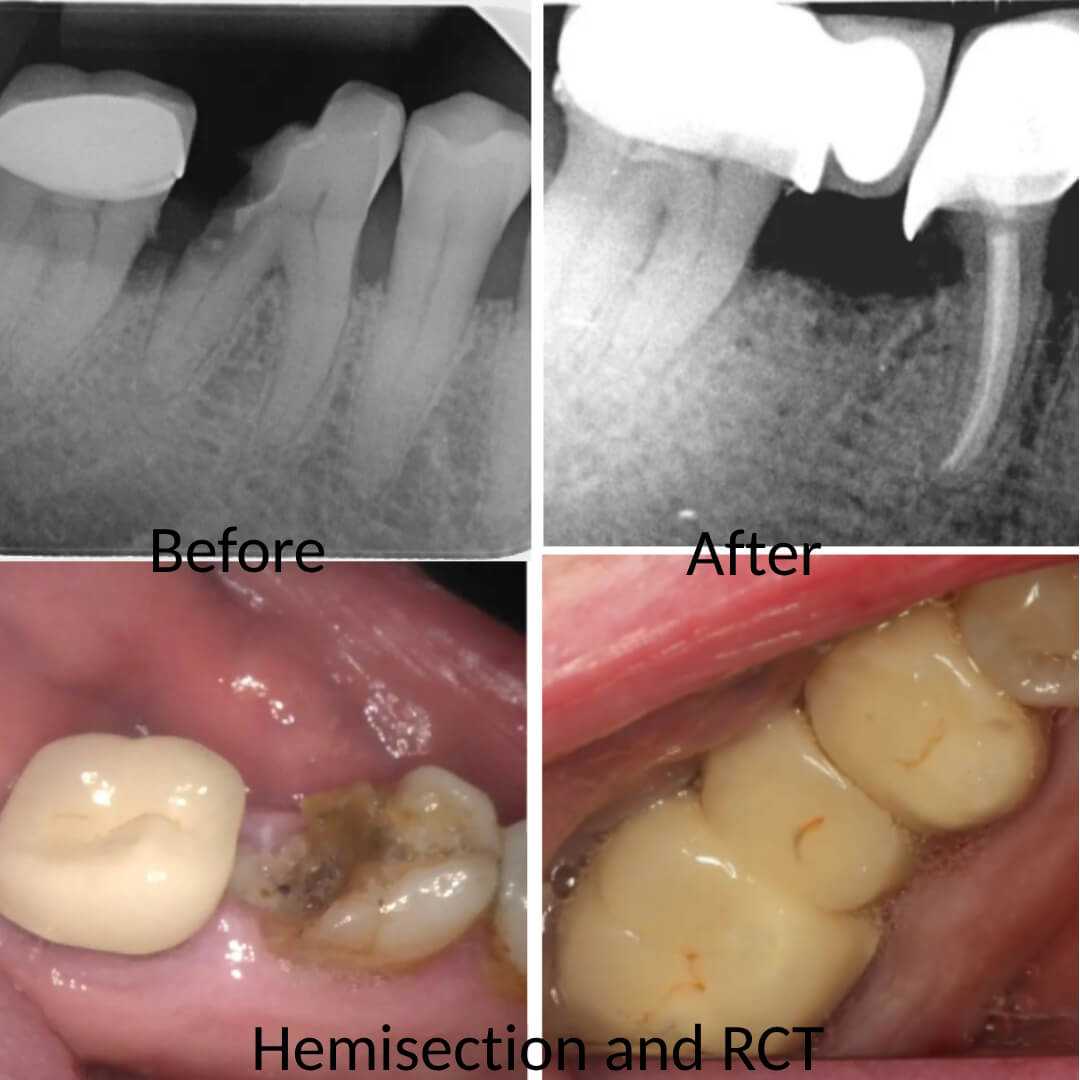 hemisection before and after