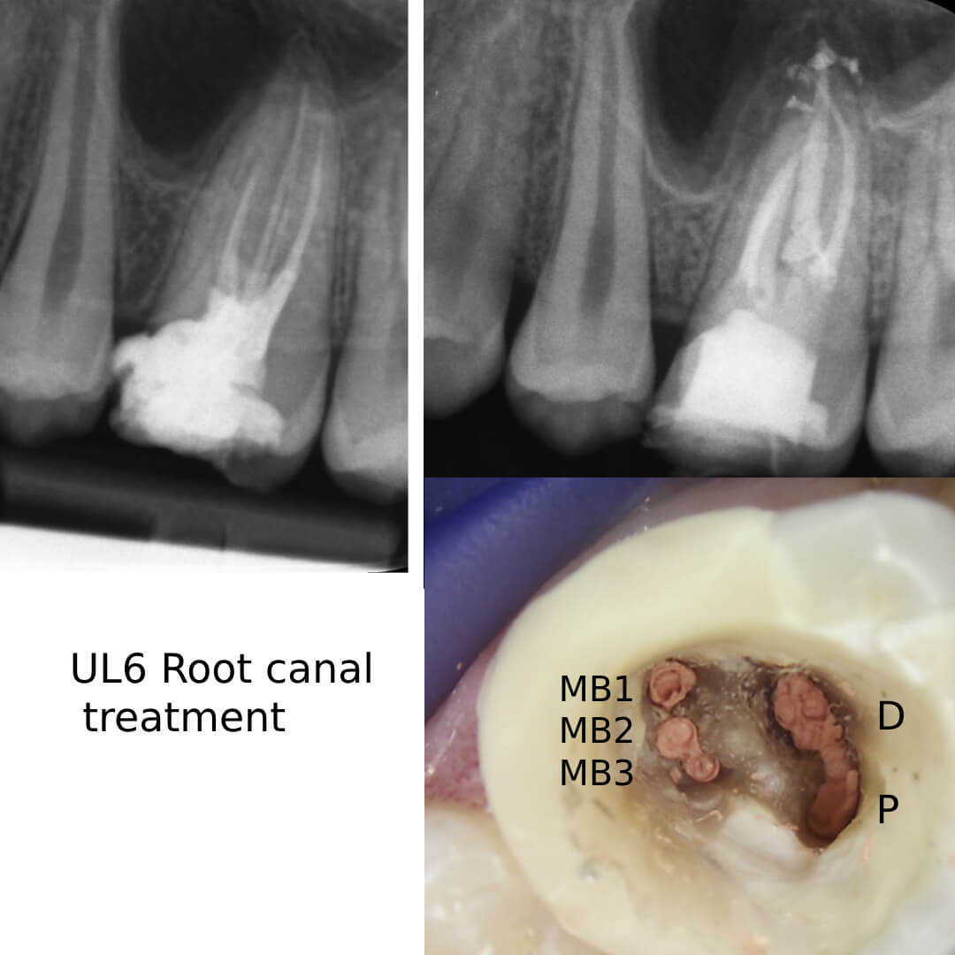Root canal retreatment before and after